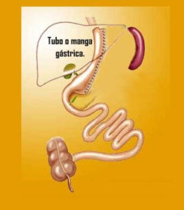 MANGA GASTRICA o TUBO G�STRICO - PARA PACIENTES OBESOS CON IMC DE 30 A 35