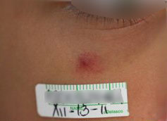 Venitas rojas en la Cara. ANTES del tratamiento Lser