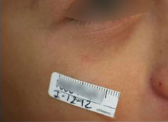 Venitas rojas en la Cara. DESPUS del tratamiento Lser