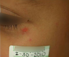 Venitas rojas en la Cara. ANTES del tratamiento Lser