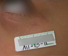 Venitas rojas en la Cara. DESPUS del tratamiento Lser