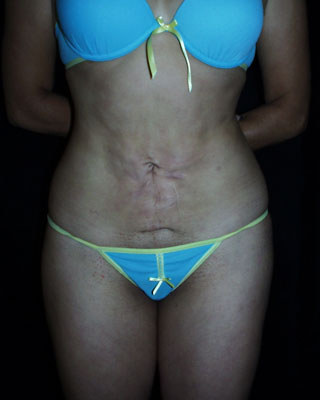 Liposucci�n imperfecta, mal hecha