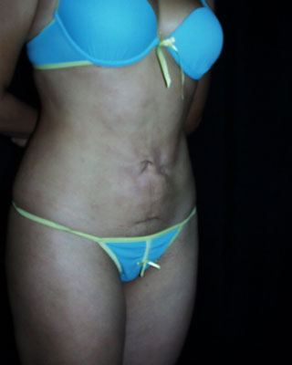 Liposucci�n mal hecha