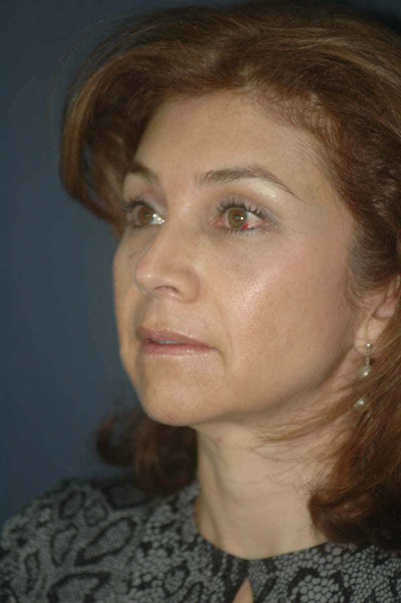 FRONTOPLASTIA ENDOSCÓPICA. - La Frontoplastia Endoscópica es el  rejuvenecimiento de la frente y los párpados superiores