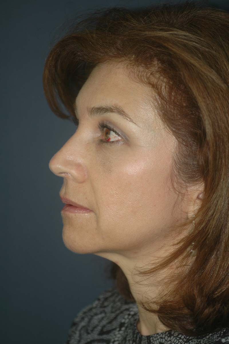 FRONTOPLASTIA ENDOSCÓPICA. - La Frontoplastia Endoscópica es el  rejuvenecimiento de la frente y los párpados superiores