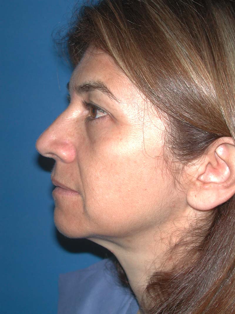 FRONTOPLASTIA ENDOSCÓPICA. - La Frontoplastia Endoscópica es el  rejuvenecimiento de la frente y los párpados superiores