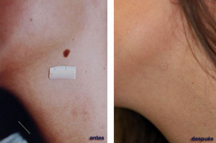 Lunares en el Cuello. Cmo quitarlos o eliminarlos con Lser. En la foto de ANTES (izquierda) se ve un gran lunar ANTES del tratamiento en Unilaser Mdica. A la derecha est la foto de DESPUS del tratamiento, donde ya no se v el lunar en el cuello.