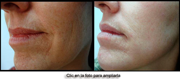 rejuvenecimiento3ad-p