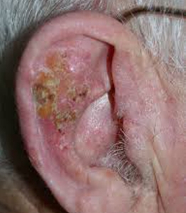 queratosis actinica en orejas