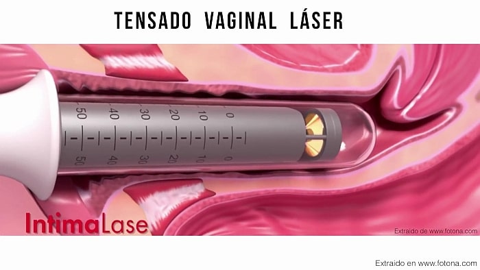 grafico sobre el tratamiento de tensado vaginal laser